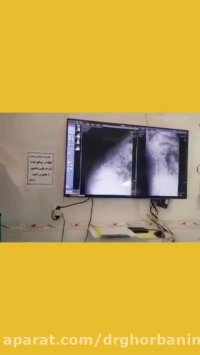 عوامل فیکساسیون ستون فقرات