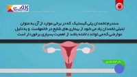 علل و نشانه های تخمدان پلی کیستیک در زنان