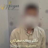 ریزش مو ناشی از اختلال خواب