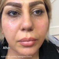 تزریق گودی زیر چشم