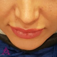 نمونه کار واقعی تزریق فیلر چانه