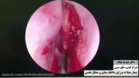 فیلم عمل جراحی برداشتن شاخک میانی به علت مشکل تنفسی