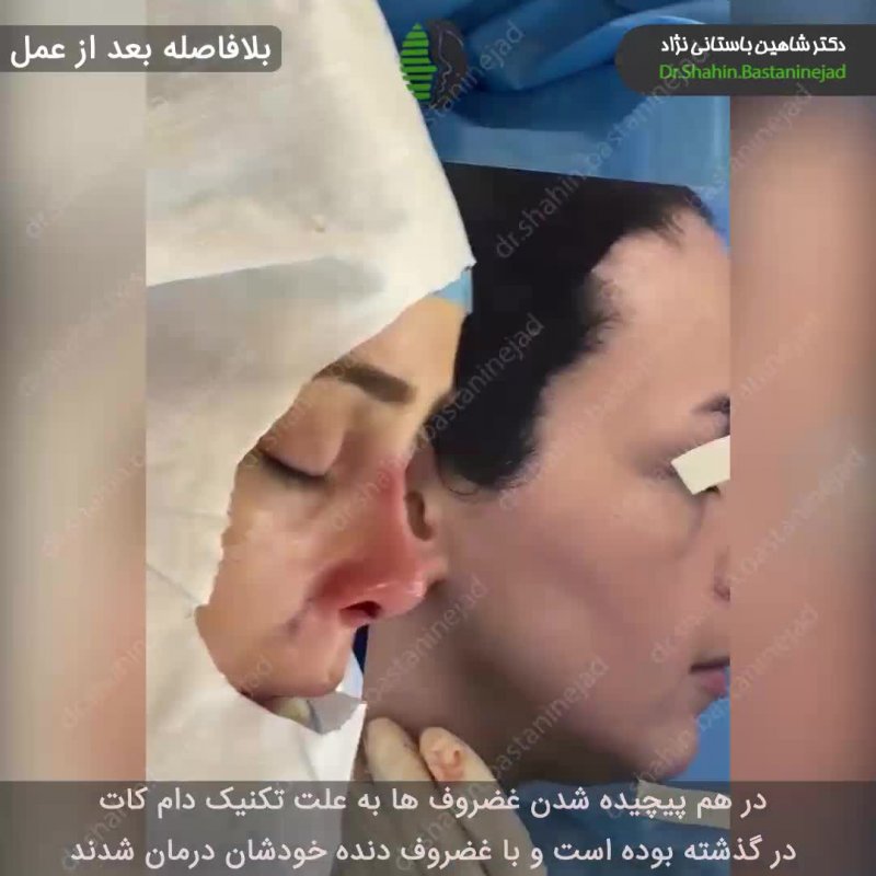 جراحی بینی ترمیمی بسیار مشکل | دکتر باستانی نژاد بهترین جراح بینی ترمیمی تهران