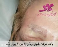 پاک کردن تاتوی رنگی با  لیزر اربیوم یگ