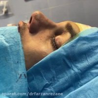 فیلم جراحی بینی مردانه