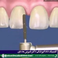 اصلاح فاصله بین دندان‌های جلوی دهان بدون ارتودنسی و با استفاده از روكش