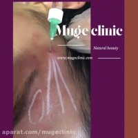 تزریق ژل به شقیقه