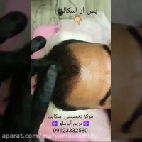 انجام اسکالپ پس از کاشت مو