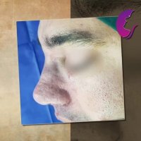 فیلم قبل و بعد از عمل بینی گوشتی