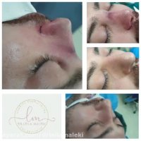 عمل بینی در مردان