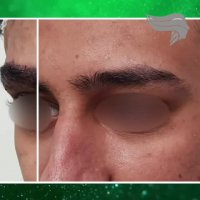 نمونه کاشت ابرو برای آقا توسط دکتر زمانی نیا