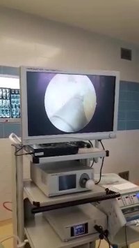 لیزر پارگی رباط صلیبی دکتر حبیب رشادی