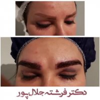 فیلم کاشت ابرو