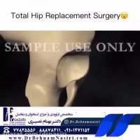 تعویض مفصل ران