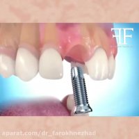 مراحل ایمپلنت دندان