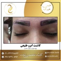 کاشت ابرو طبیعی | کلینیک پایتخت | 44228594-021