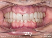 بازسازی دندانهای بیمار عزیزمان با ایمپلنت دندان و روکش