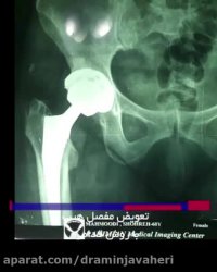 تجربه جراحی تعویض مفصل لگن از زبان بیمار