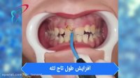 افزایش طول تاج دندان