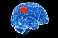 درمان تومور مغز با تزریق ویروس
