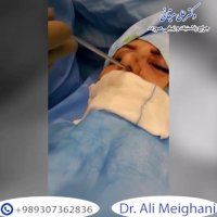 فیلم برداشتن بیش از حد غضروف در عمل بینی