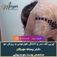 ریزش مو با چربی کف سر و اختلالات هورمونی