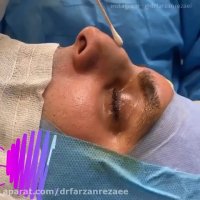 فیلم جراحی بینی مردانه به روش بسته