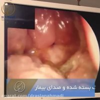 سرطان وسیع حنجره ناحیه سوپراگلوت