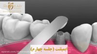 ایمپلنت دندان در جلسه چهارم
