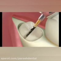 جراحی دندان عقل