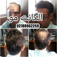 ترمیم موی الگانت /02188962259/پروتز مو