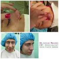 فیلم نتیجه جراحی بینی گوشتی