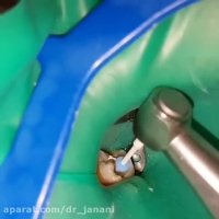 درمان ریشه دندان (عصب كشی)