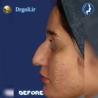 یکسال و نیم بعد از جراحی بینی نیمه فانتزی | دکتر گلی