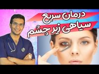 درمان فوری سیاهی زیر چشم ها