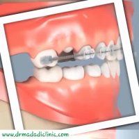 کشیدن دندان شیری