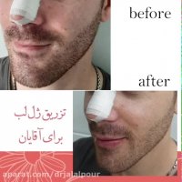 فیلم تزریق طبیعی ژل لب آقایان دکتر فرشته جلال پور