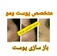 از بین برنده ترک های پوستی و درمان جای جوش !!! قطعی و بدون بازگشت