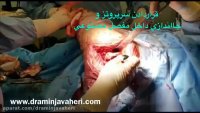 عمل جراحی تعویض مجدد مفصل لگن توسط دکتر علیرضا امین جواهری