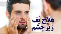 علت پف زیر چشم و رابطه اش با کمبود کدام ویتامین ها