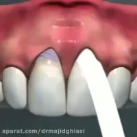 اصلاح طرح لبخند-دکترمجیدقیاسی دندانپزشک زیبایی مشهد