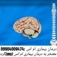 پزشکان ایرانی برای اولین بار موفق به درمان بیماری ام اس گردیدند(کارشناس:امیری)