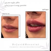 فیلم تزریق ژل لب