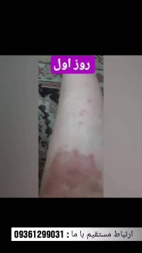 راهکار درمانی قطعی برای بیماری اگزمای پوستی