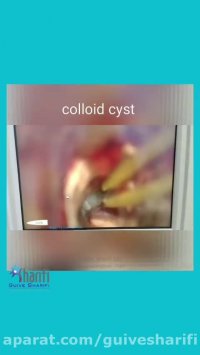 208. فیلم جالبی از کیست کلوئیدی یا colloid cyst