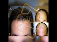 کاشت مو به روش SUT مرکز مو رنسانس
