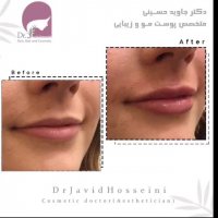 فیلم تزریق ژل لب