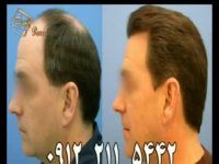 کاشت مو به روش SUT مرکز مو رنسانس