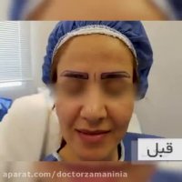 راحت ترین روش کاشت ابرو