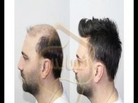 کاشت مو به روش SUT مرکز مو رنسانس